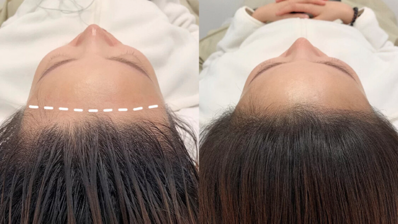 How Can a Scalp Micropigmentation Change Your Life